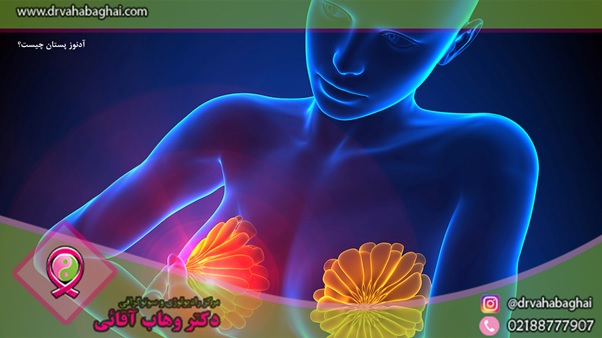 آدنوز پستان چیست؟