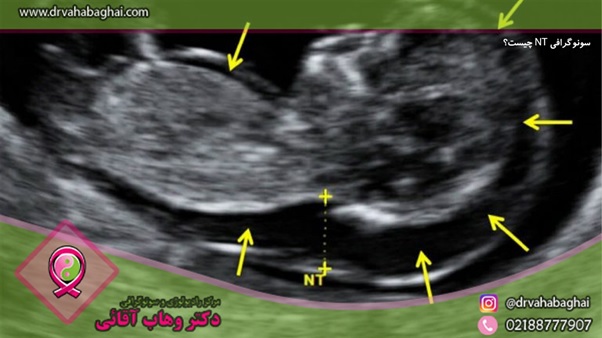 سونوگرافی nt