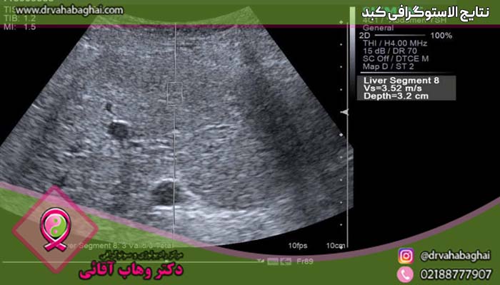 نتایج الاستوگرافی کبد