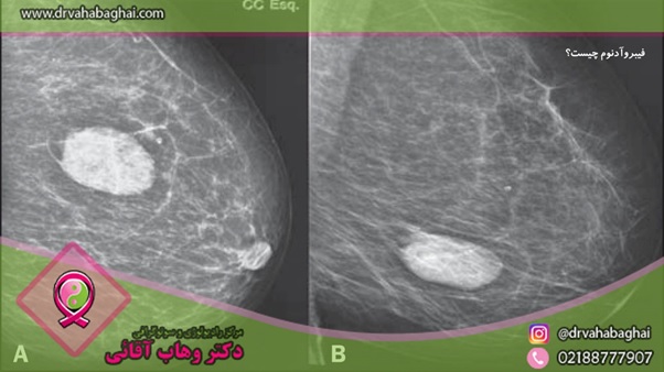 فیبروآدنوم