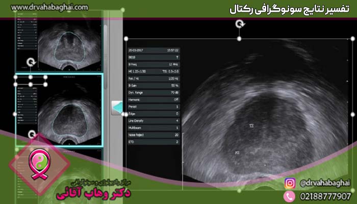 تفسیر نتایج سونوگرافی رکتال