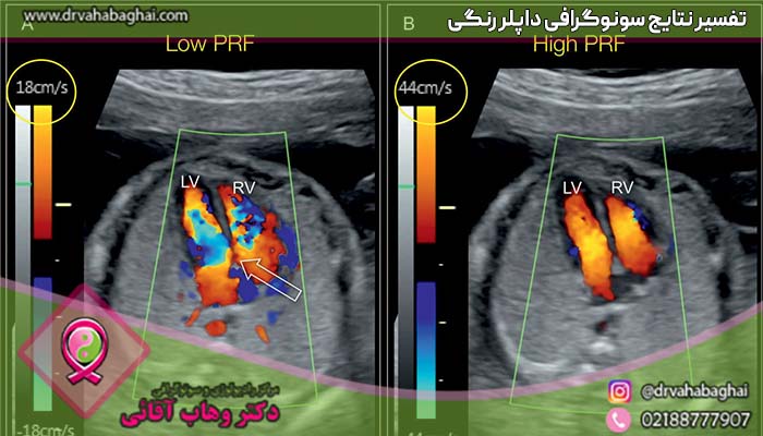 تفسیر نتایج سونوگرافی داپلر رنگی