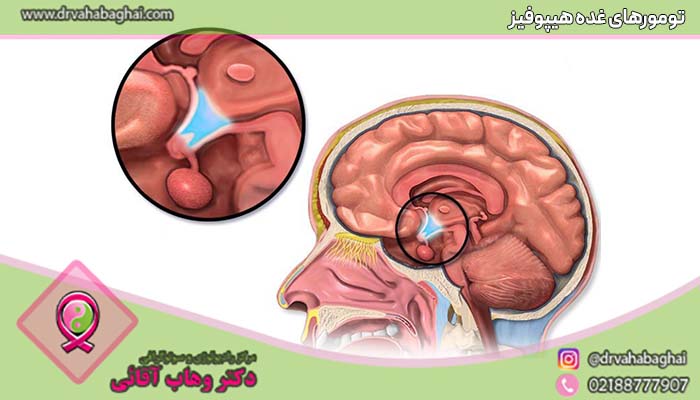 تومورهای غده هیپوفیز