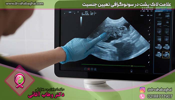 علامت لاک پشت در سونوگرافی تعیین جنسیت