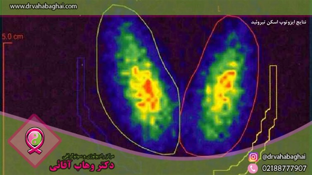 نتایج اسکن تیروئید