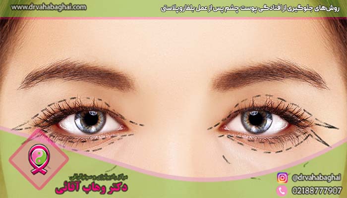 روش های جلوگیری از افتادگی پوشت پشت چشم پس از بلفاروپلاستی