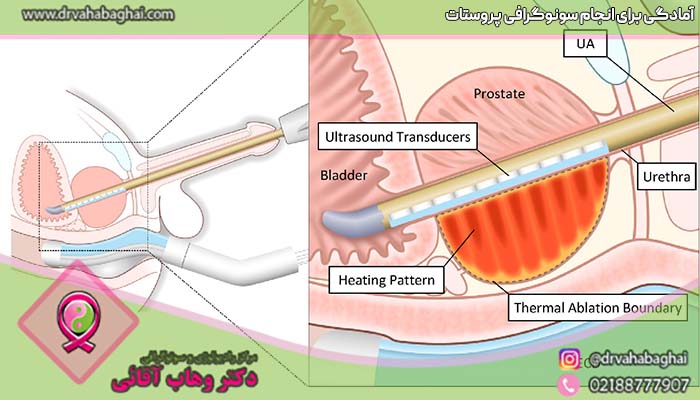 آمادگی برای انجام سونوگرافی پروستات