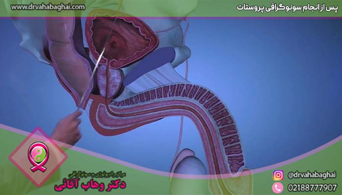 پس از انجام سونوگرافی پروستات