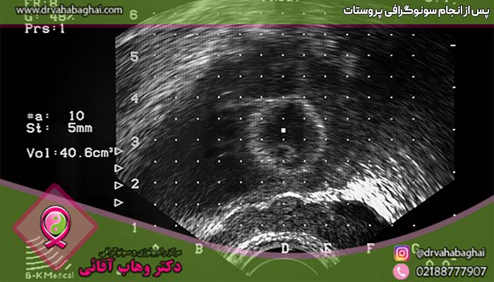 گام بعد سونوگرافی پروستات