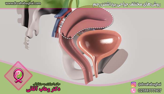 روش های مختلف عمل برداشتن رحم