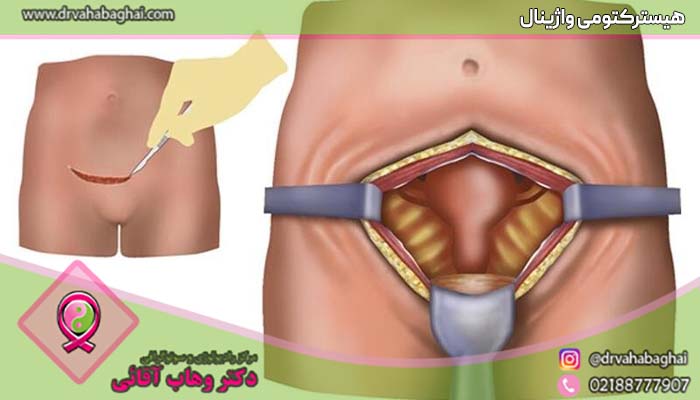 عمل برداشتن رحم واژینال