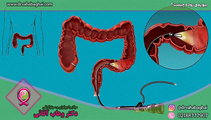 بیوپسی روده چیست