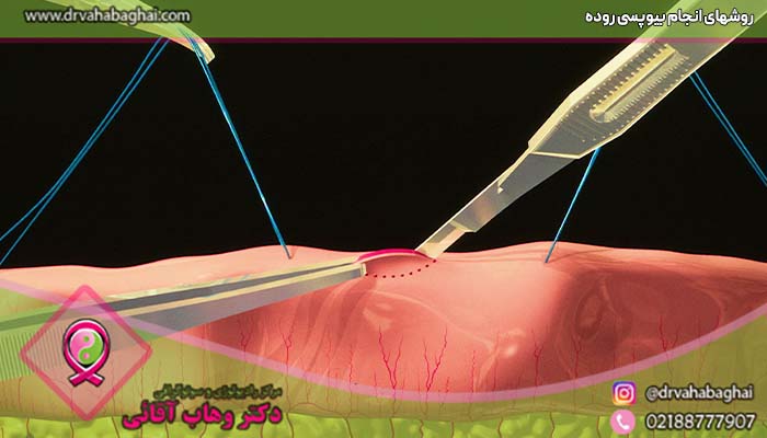 روشهای انجام بیوپسی روده