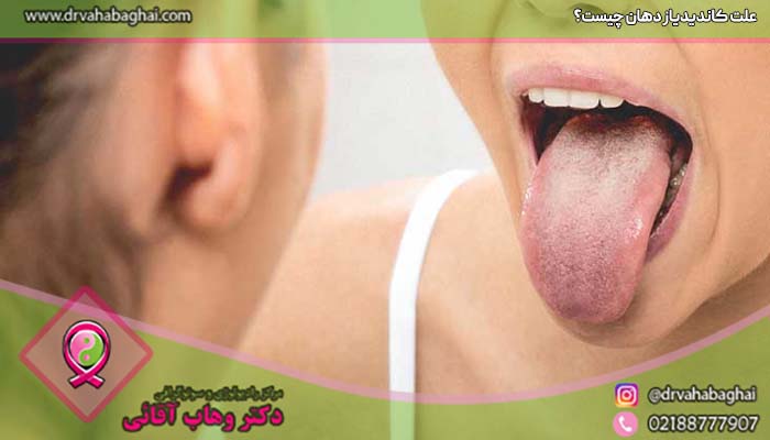 بیماری کاندیدیاز  دهان