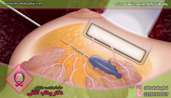 روش های انجام نمونه برداری پستان