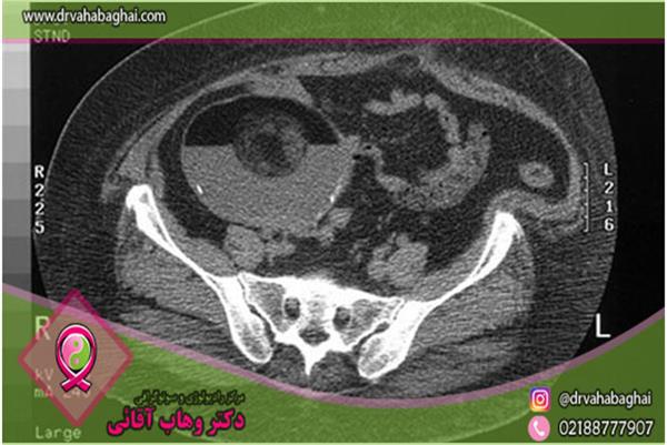 کیست درموئید تخمدان