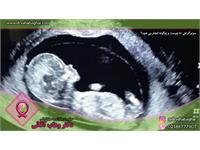 سونوگرافی NT