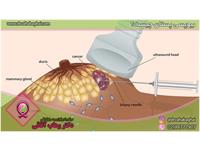 بیوپسی پستان چیست