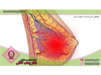 چگونگی درمان ماستیت یا عفونت پستان