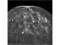 کلسیفیکاسیون پستان