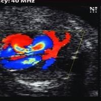 سونوگرافی کالر داپلر