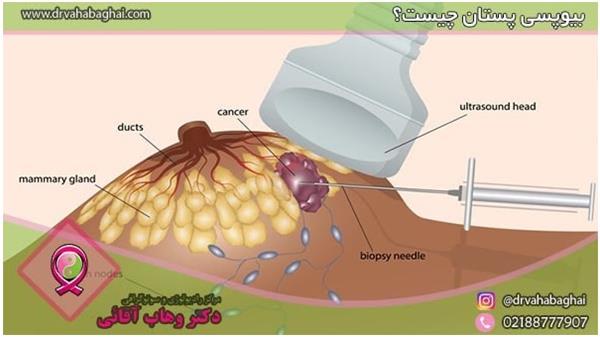 نمونه برداری پستان یا بیوپسی چیست؟ و انواع آن