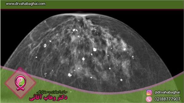 کلسیفیکاسیون پستان چیست و چگونه درمان می‌شود؟