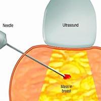 بیوپسی پستان