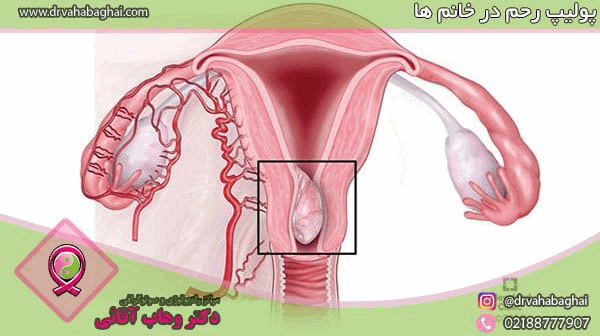 پولیپ‌های رحم در خانم‌ها