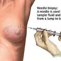 بیوپسی تحت گاید سونوگرافی