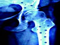 روش تشخیص پوکی استخوان