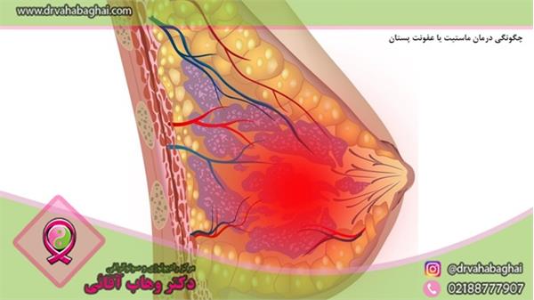 چگونگی درمان ماستیت یا عفونت پستان