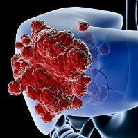 درمان سرطان کبد