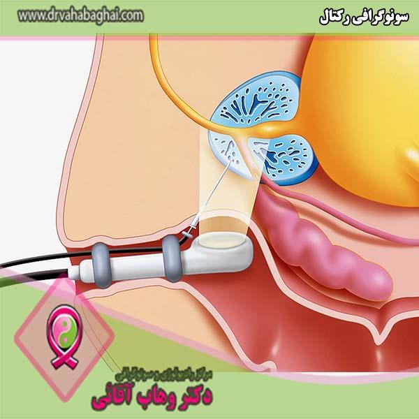 سونوگرافی رکتال: کاربردها، عوارض و نحوه انجام