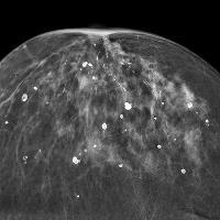 کلسیفیکاسیون پستان