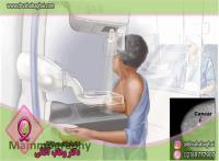 ماموگرافی چیست