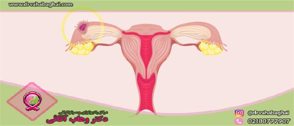 حاملگی خارج از رحم چیست؟ علائم،تشخیص و درمان آن