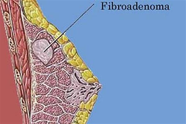فیبروآدنوم (Fibroadenoma)