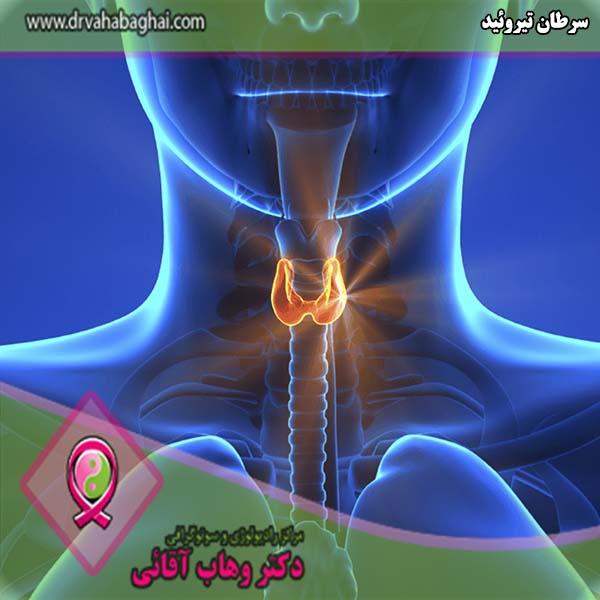 سرطان تیروئید، علائم، تشخیص و درمان آن