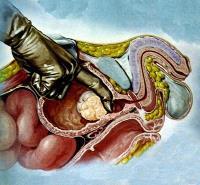 بزرگ شدن پروستات