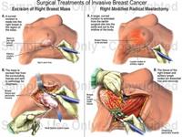 جراحی های سرطان پستان