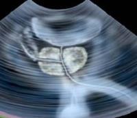 هزینه سونوگرافی پروستات