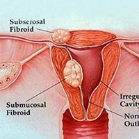 پولیپ رحم و درمان