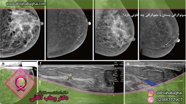 سونوگرافی پستان با ماموگرافی چه تفاوتی دارد؟