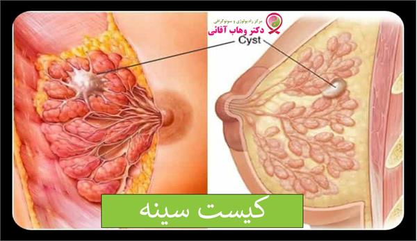 علائم، تشخیص و درمان کیست سینه ( فیبروکیستیک سینه )