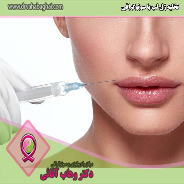 تخلیه ژل لب با سونوگرافی چگونه انجام می شود؟