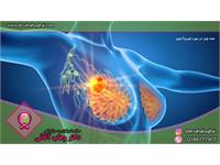 فیبروآدنوم چیست؟