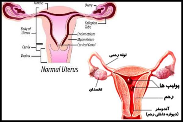 تخمدان چیست و بیماری‌های مربوط به آن