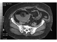 کیست در موئید تخمدان